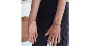 İstanbul’da maymun çiçeği virüsü şüphesi! Test sonuçları bekleniyor